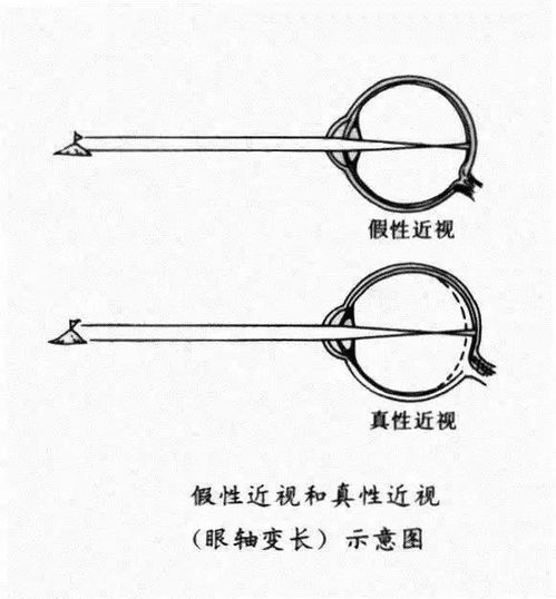 嗨视力专业验光配镜丨孩子遇上 假 性近视,先别着急配眼镜