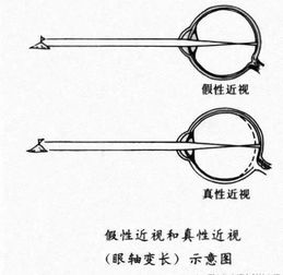 假性近视与真性近视的区别